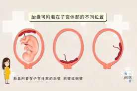 视频｜有问医答：孕期胎盘低置该怎么办？图片