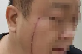 男子拍打“毒虫”引发皮肤炎症！专家：遇隐翅虫要用力吹走，千万别拍图片