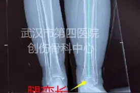 弯短腿变长直腿，医生“乾坤大挪移”治好骨折后遗症图片