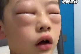 男孩每天双眼发肿，原来是……图片