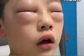 男孩每天双眼发肿，原来是……图片