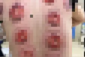 跟风半小时！男子身上密密麻麻……医生紧急提醒：自行操作风险太大图片