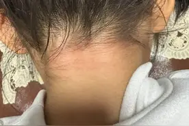河南济源5岁女童颈部出现红痕，家人查看监控后气炸：幼儿园老师掐着脖子将她提起来图片
