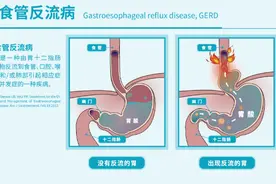 寝食难安！八旬老人被确诊患胃食管反流，术后终于“躺平”了图片