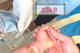 1岁幼童被502胶水“烧伤” 局部皮肤坏死需植皮图片