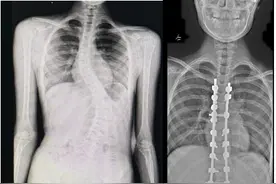 11岁女孩“坐没坐相”竟是脊柱重度侧弯畸形，矫形手术后挺直腰杆图片