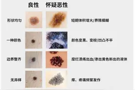 太可怕！厦门一男子点“痣”后越长越大，原因竟是……图片
