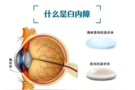 白内障成熟才能做手术？错啦！图片
