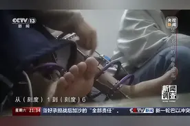 “腿喷脓了，挤也挤不完”，女子出国做手术断骨增高，右腿感染严重图片