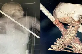 1米钢筋右颈插入，左腋下穿出！华西胸外科成功救治这名贯通伤重症患者图片