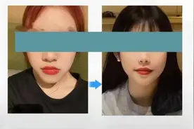 嘴凸、地包天、龅牙以及大小脸如何治？正颌、正畸还是正颌正畸联合诊疗，这里一次说透图片