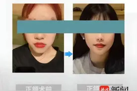 嘴凸、地包天、龅牙以及大小脸如何治？正颌、正畸还是正颌正畸联合诊疗，这里一次说透图片