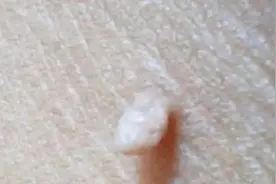 身上长出的“小肉粒”会癌变吗？看到这样的“小肉粒”要小心！图片