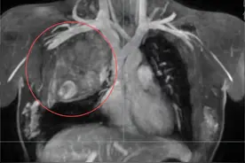 12岁女孩胸腔内长足球大肿瘤，压迫神经节……“达芬奇”机器人精准微创切除图片