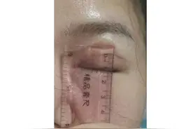 女子做双眼皮手术，结果有12毫米宽！绷不住了：朋友说我像“悲伤蛙”图片
