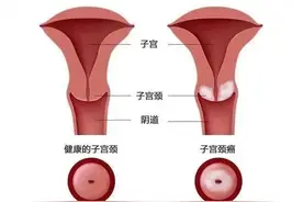 【朝医科普】守护女性健康的隐形盾牌：宫颈癌筛查与诊疗全攻略图片