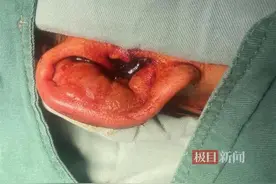 16岁女孩在耳骨上打耳洞，半年后致软骨近乎坏死图片