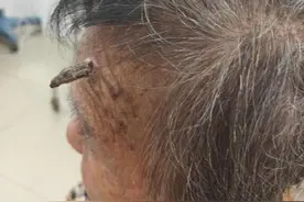 头上有犄角！广西62岁阿姨头上长出牛角图片