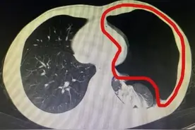 男子上厕所太用力，竟把肺憋“炸”了！医生提醒图片