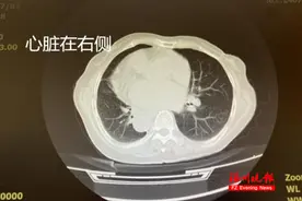 罕见！福州一女子竟是“镜面人”！一辈子无症状，医生却紧张……图片