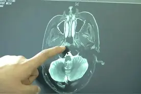 “以为普通感冒”！女子鼻塞两个月，竟确诊癌症......这些症状千万警惕图片