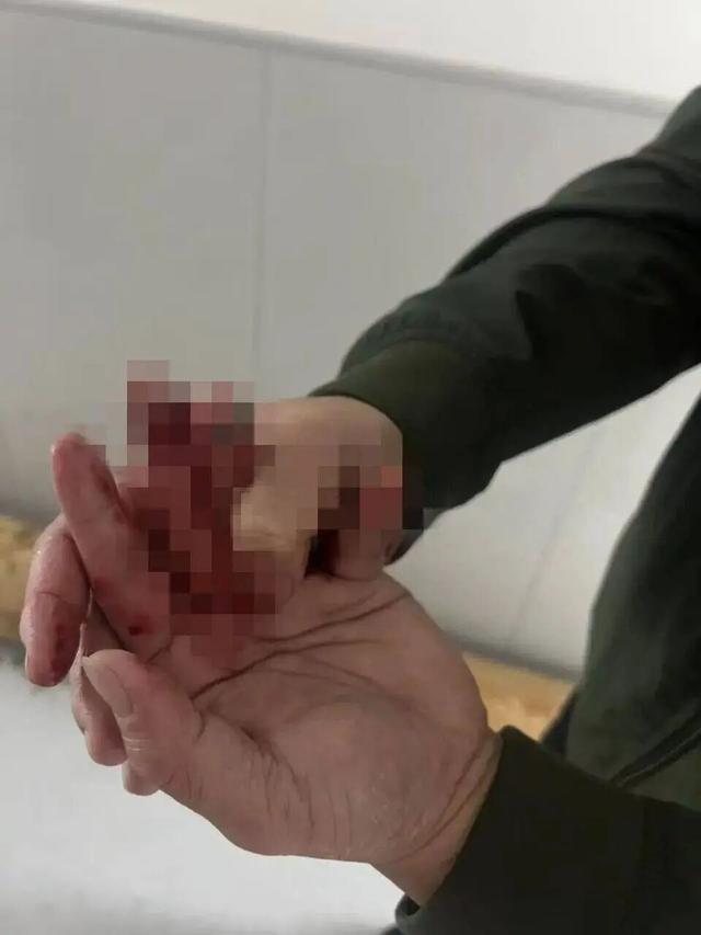 民警救车祸被困者时手指被车门夹断