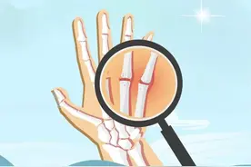 “痛风石”如何化解？广东药企加速研发新药｜世界痛风日图片