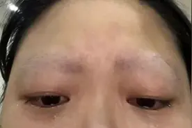 重庆一女子被家养鹦鹉啄光眉毛，当事人回应图片