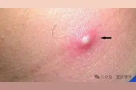 “疖子”虽小，后患无穷图片