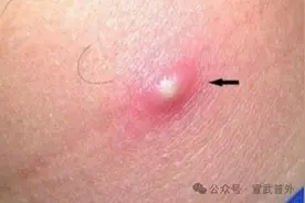 “疖子”虽小，后患无穷图片