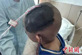 广东患儿成功“换肤”切除巨型黑毛痣图片