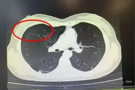 28岁女子减肥跳绳后“肺炸了”：1个月狂瘦20斤图片