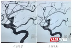 永州市第四人民医院神经内科“拆弹专家”成功为患者解除“不定时炸弹”图片