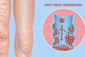 世界血栓日|这些人最易被血栓“拴住”，秋燥时节这五个时刻更要记得喝水图片