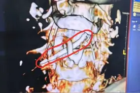 惊险！62岁老人被巨大鱼骨卡喉！医生紧急提醒图片