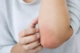 科普｜春季过敏皮肤病高发 专家提醒：青少年特应性皮炎需引起重视图片