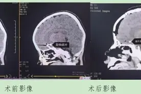 学生不慎将圆珠笔插入颅内！专家：不可贸然拔出穿刺物图片