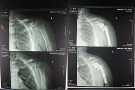 60多岁钓鱼爱好者钓出肩关节病？专家：钓鱼养身养心，也要注意方式图片