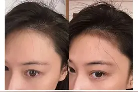 张馨予“斑秃”痊愈：消失的头发回来了！网友求教程图片