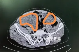 男子醉酒后摔一跤“摔爆”膀胱 医生：喝酒莫贪杯，更不要憋尿！图片
