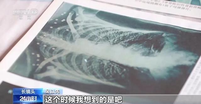 “老先生，您把项链取下来再做CT”“你看是不是弹片”
