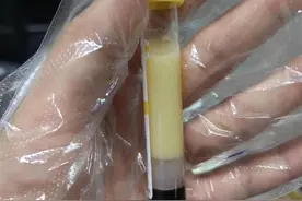 28岁小伙偏爱吃夜宵，狂炫五斤麻辣小龙虾后血液成了乳白色图片