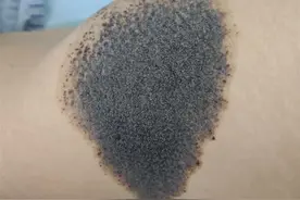 23岁女孩告别“兽皮痣”，医生妙手重塑美丽肌肤图片