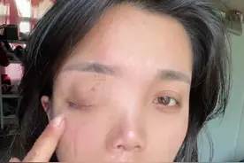 安徽女子左眼失明，办理残疾人证被拒？残联：双眼残疾可办理图片