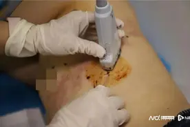 那英感染带状疱疹上热搜，中老年慢病人群高发，应主动预防图片
