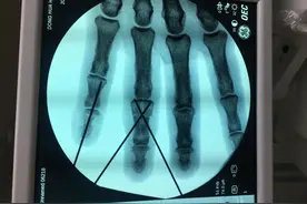 千万当回事！温州有人因指头有点“乌青”，竟险遭截肢……图片