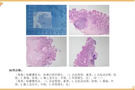 胃镜活检病理报告看不懂？别怕，看这里！图片