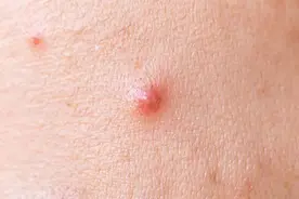 长疖子是因为上火吗图片