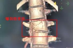 贪玩一“跳”，20岁男子腰椎骨折险瘫痪图片