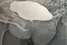 不慎摔倒致尿道断裂，30岁男子“重建尿道”获新生图片